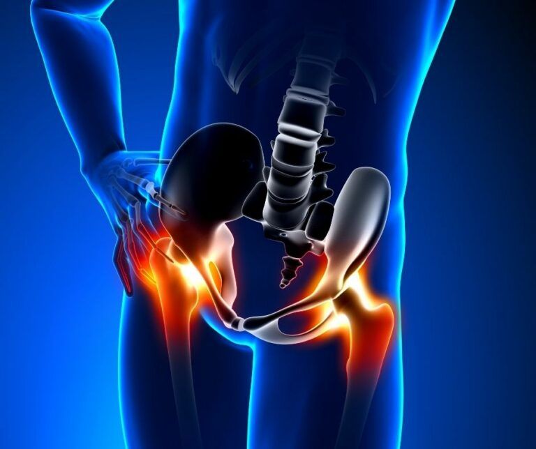 bursitis de cadera