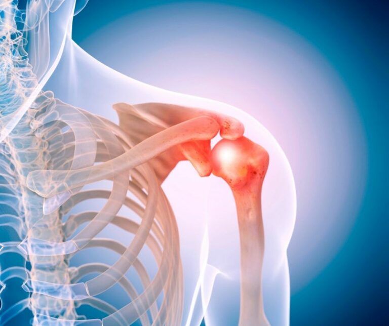 tendinitis de hombro